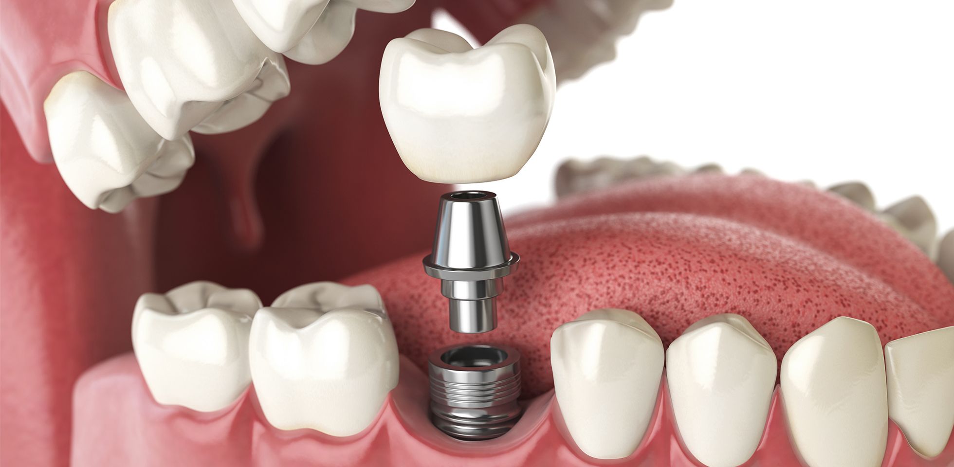 Implants